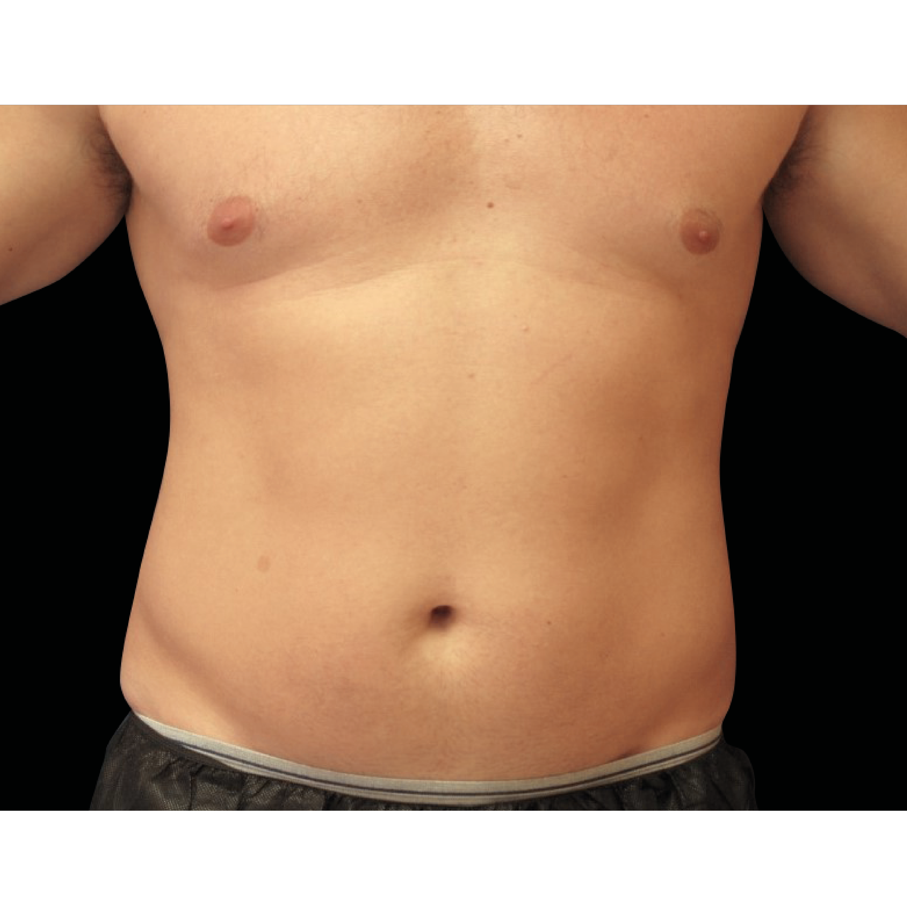 Emsculpt Neo antes 3