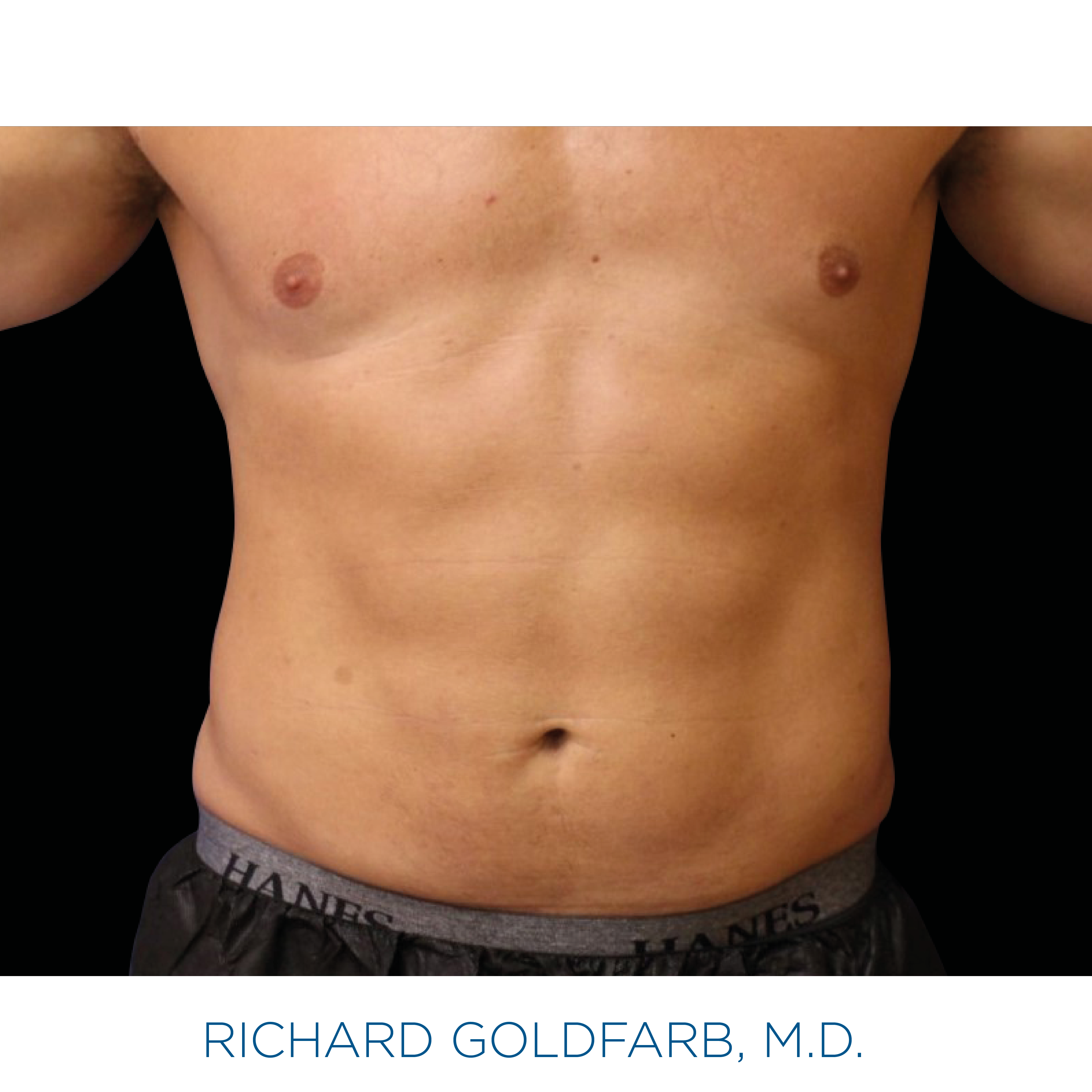 Emsculpt Neo después 3