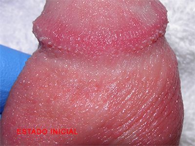 papulas perladas del pene clinixa tufet