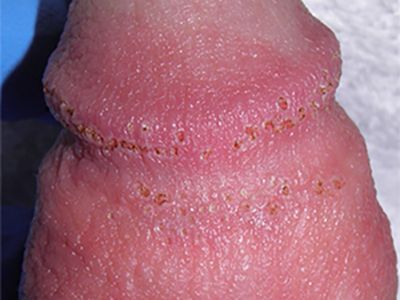 papulas perladas del pene clinixa tufet