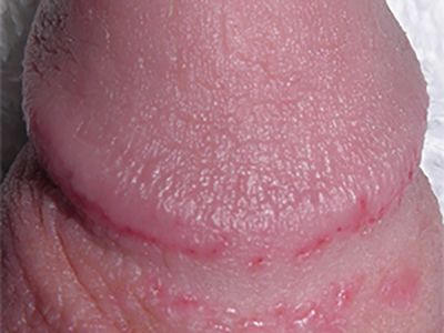 papulas perladas del pene clinixa tufet