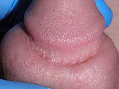 papulas perladas del pene clinixa tufet