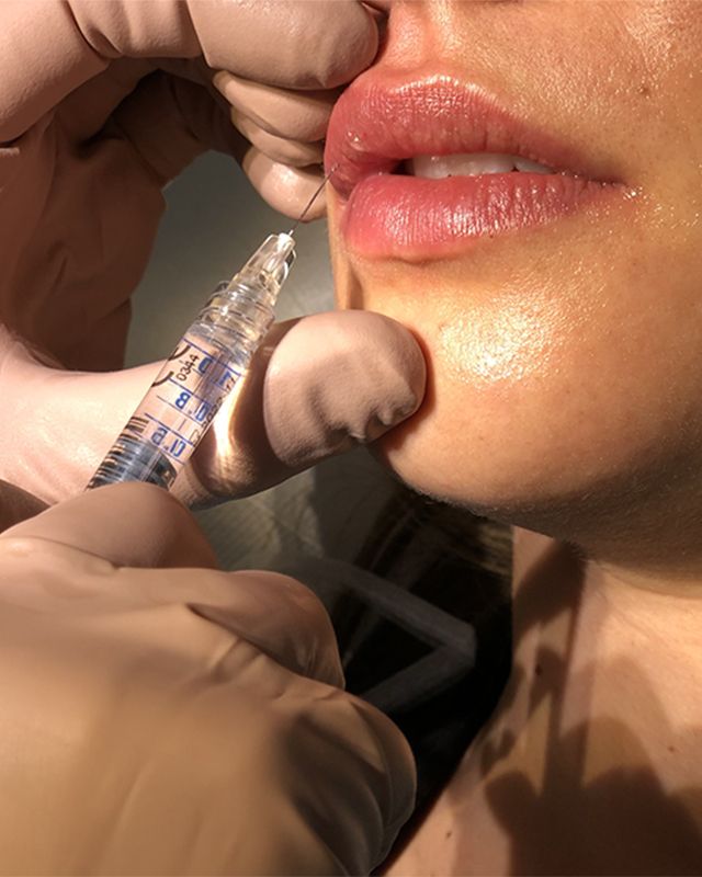 relleno de labios con acido hialuronico