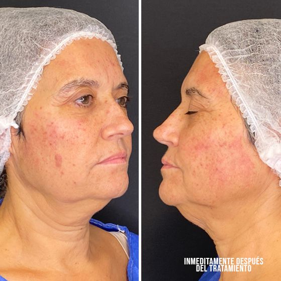 ipl luz pulsada intensa