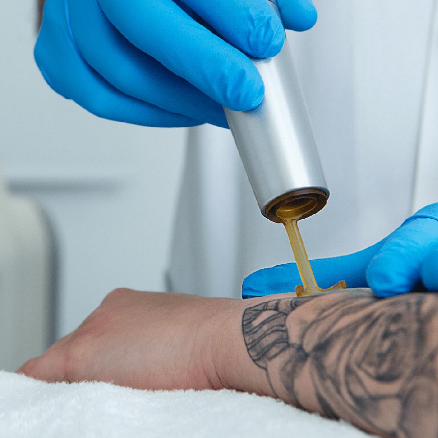 eliminacion de tatuajes medica clinicatufet