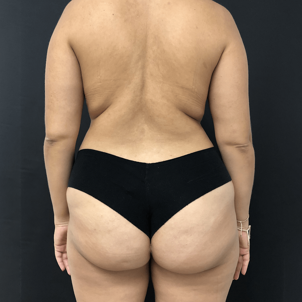 crioconcept grasa localizada clinica tufet