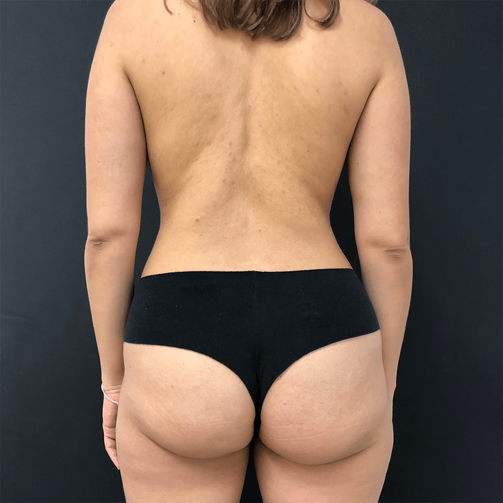 crioconcept grasa localizada clinica tufet