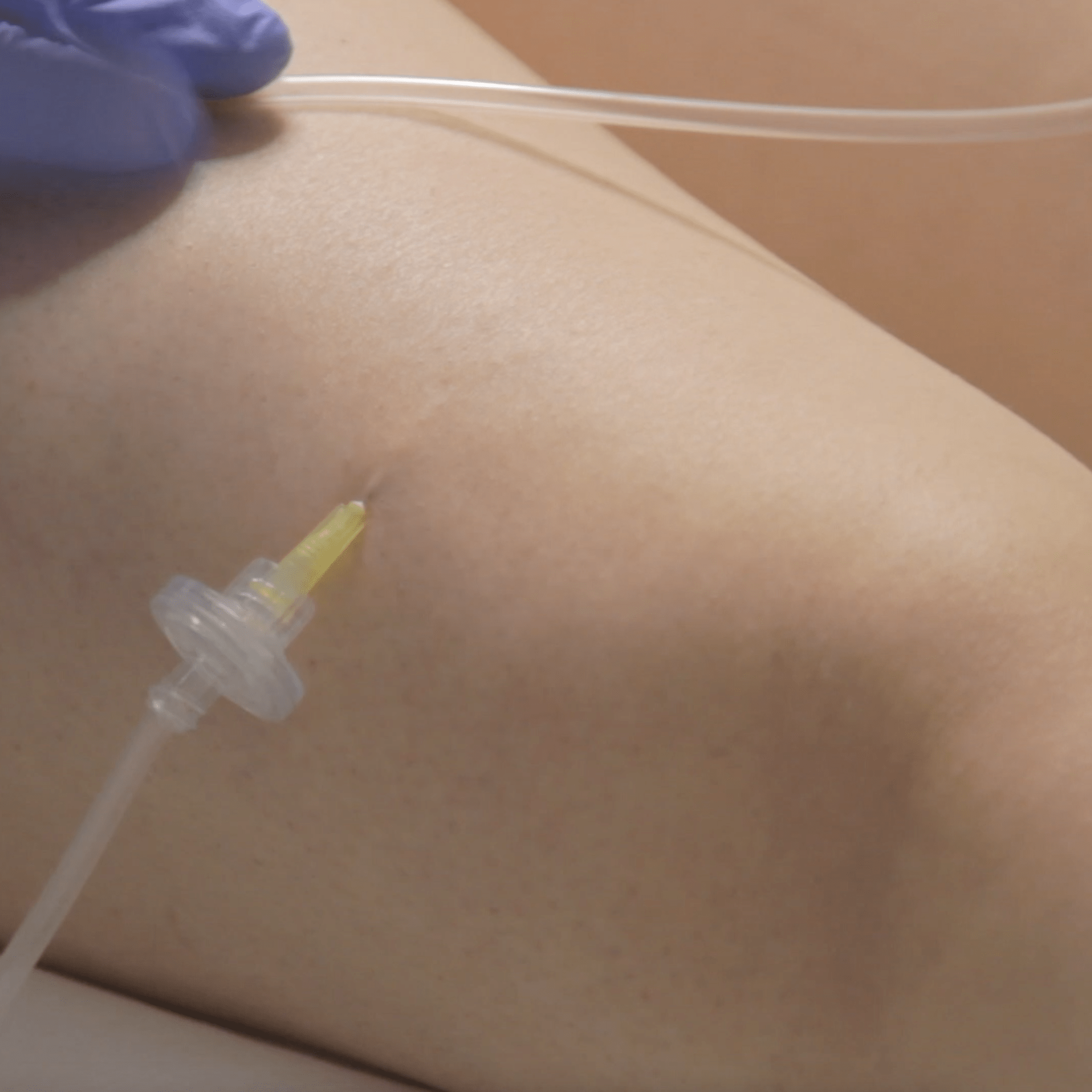 carboxiterapia corporal barcelona