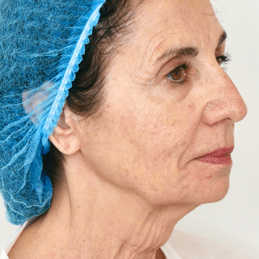 flacidez facial barcelona