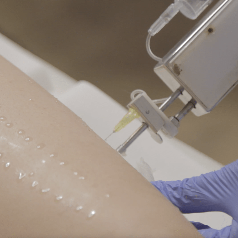 mesoterapia corporal barcelona