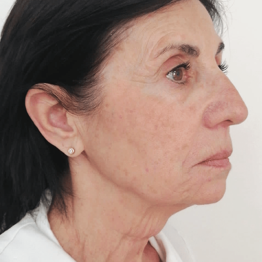 flacidez facial barcelona