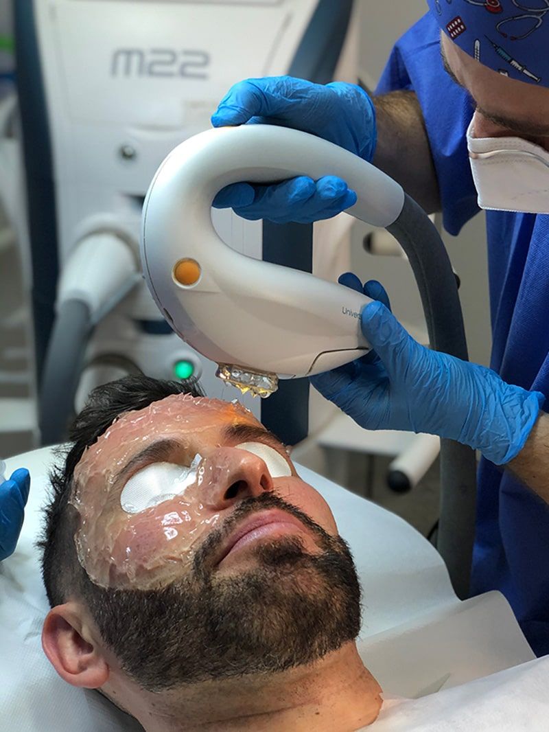 manchas faciales IPL