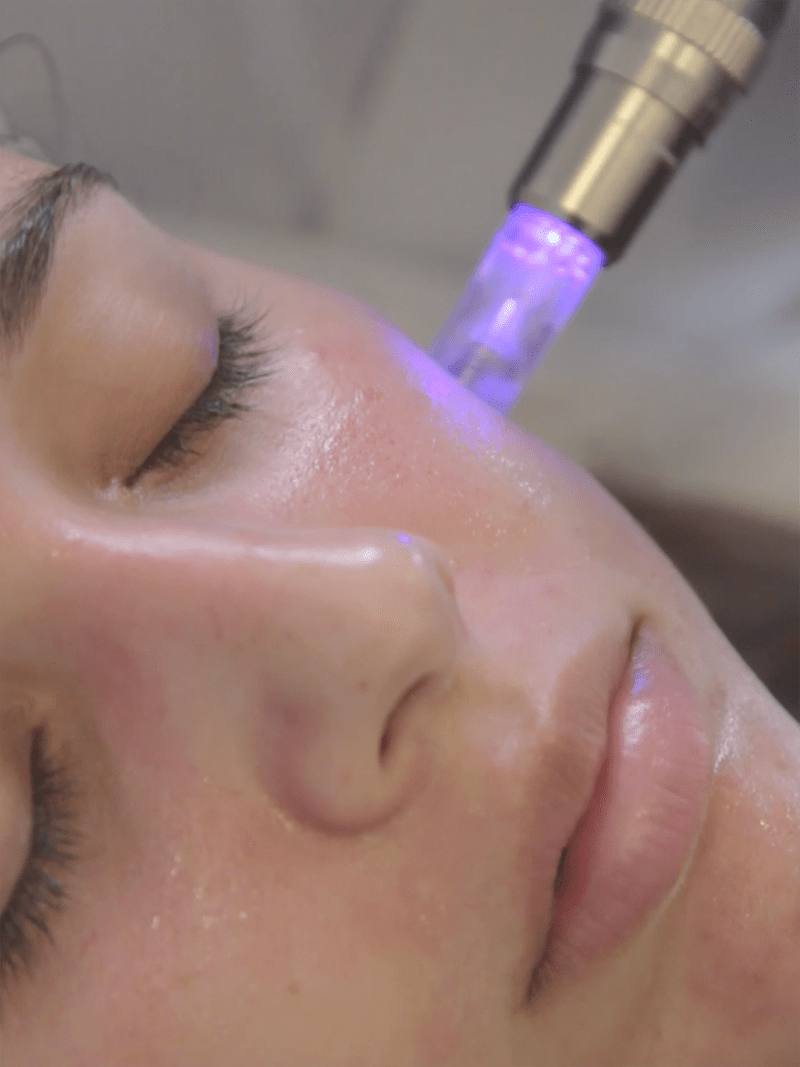 peeling quimico clinica tufet