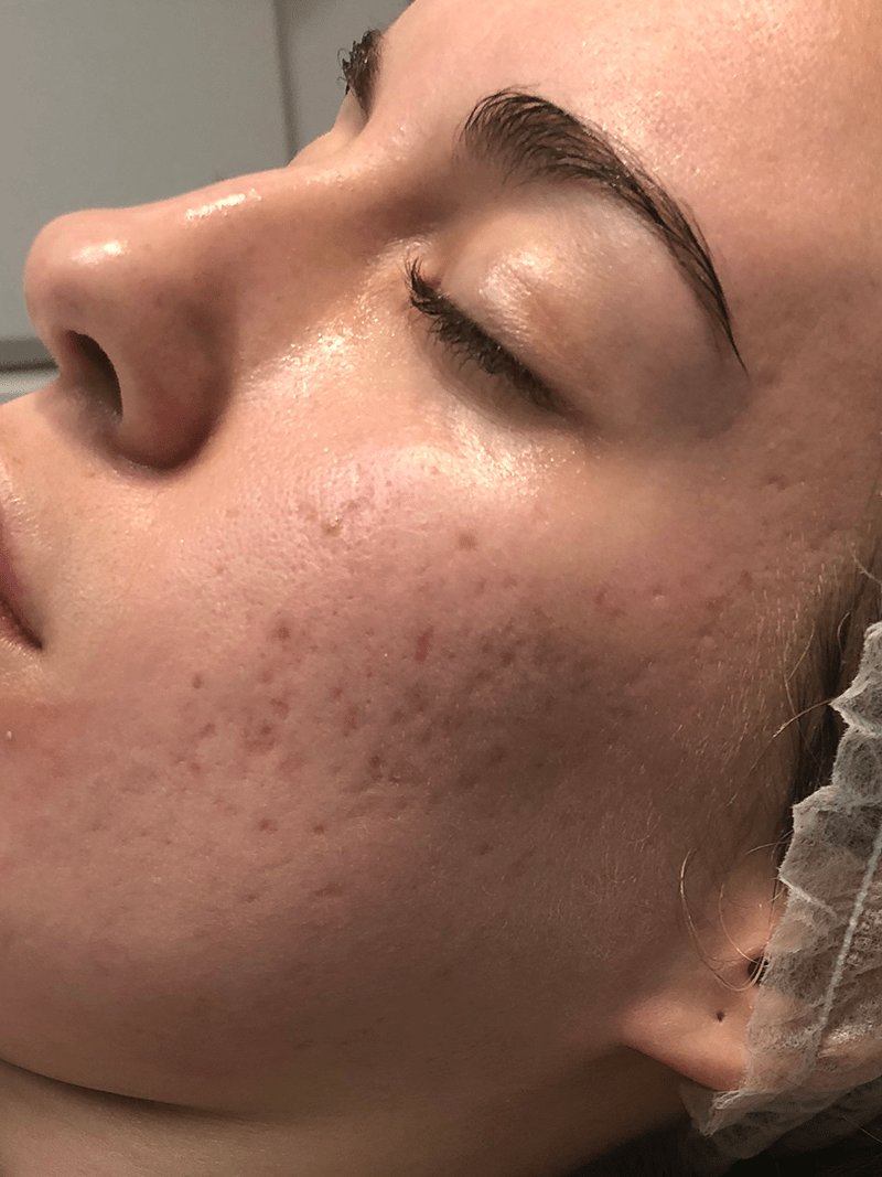 eliminar cicatrices de acné