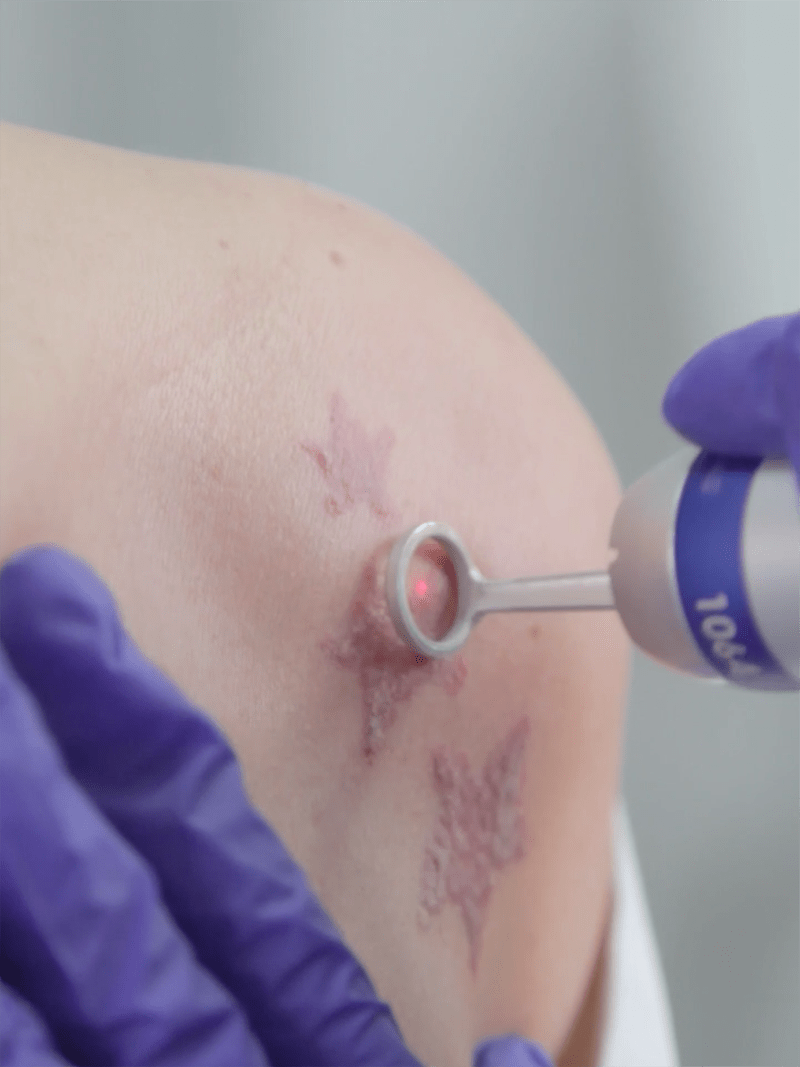 mejor clinica elimiinacion tatuajes