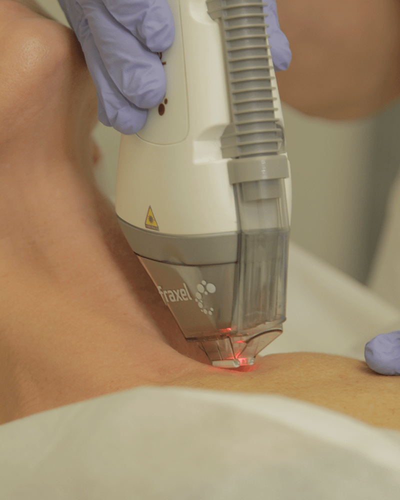 tratar manchas en el escote