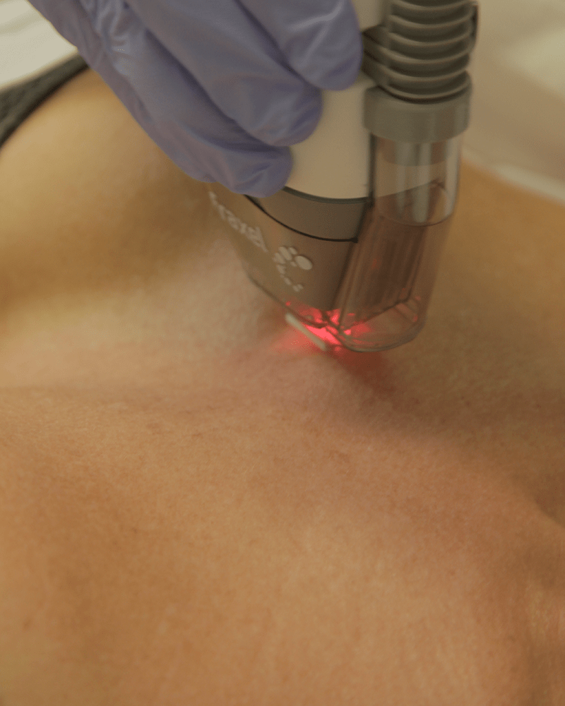 tratamiento de las mancas del escote