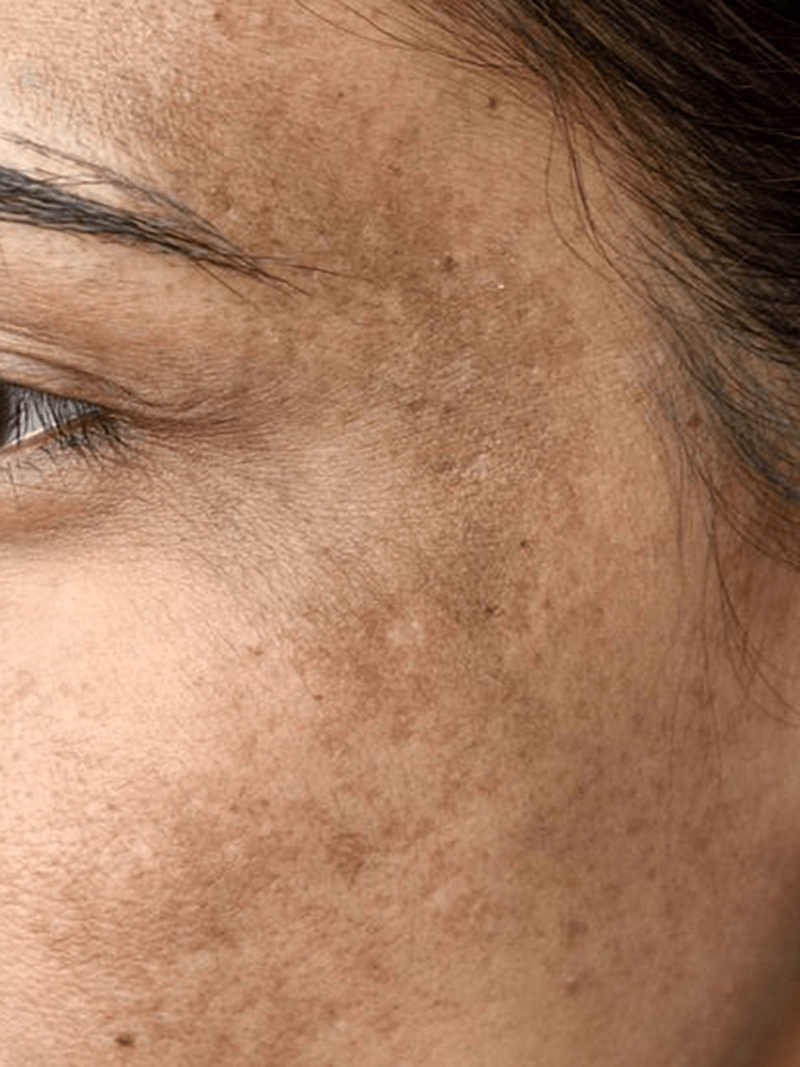 eliminar el melasma