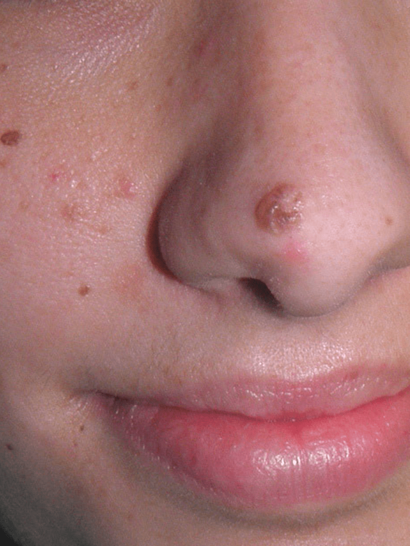 eliminacion de verrugas