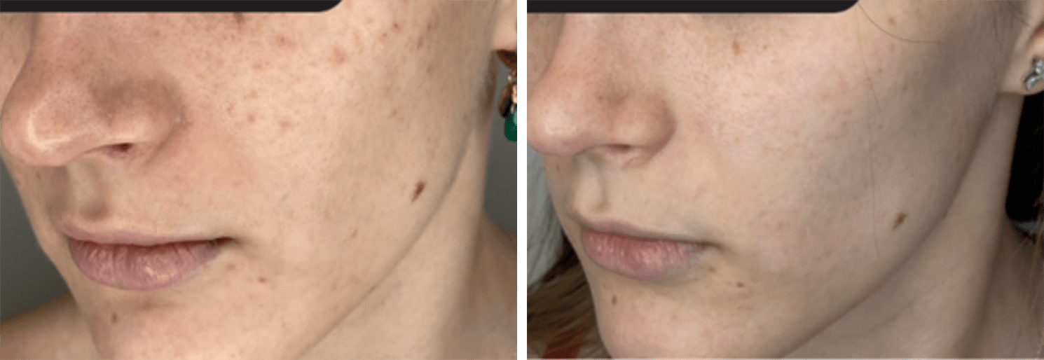 manchas de acné barcelona