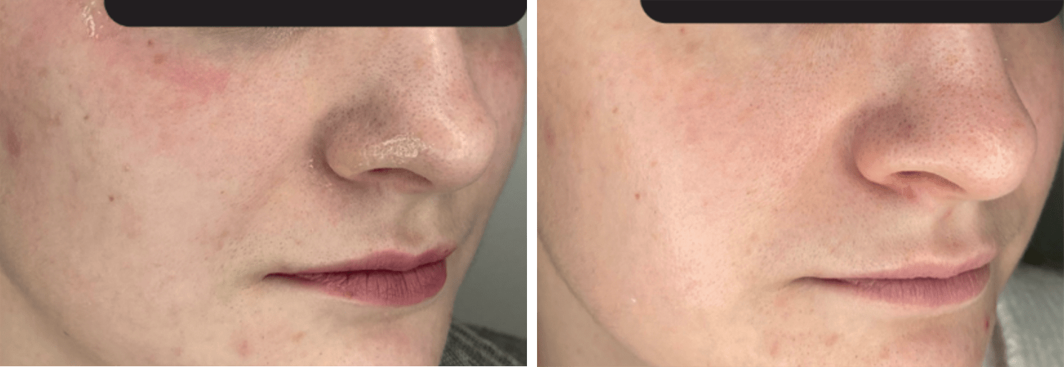 manchas de acné barcelona