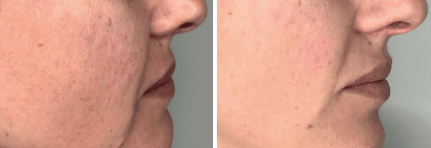 mejorar manchas de acné