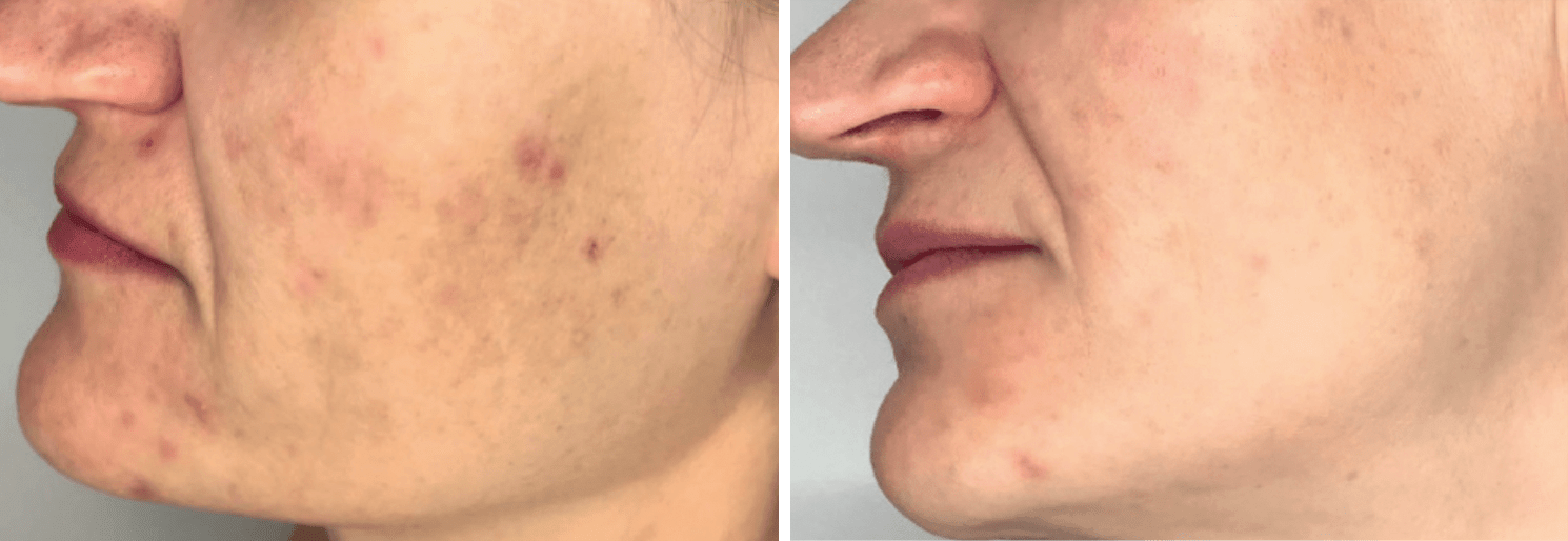 eliminar manchas de acné